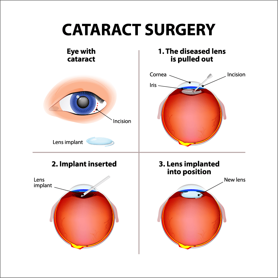 cataract surgery illustration diagram