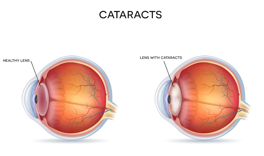 A side-by-side comparison of a healthy eye lens and an eye lens affected by cataracts for understanding cataracts