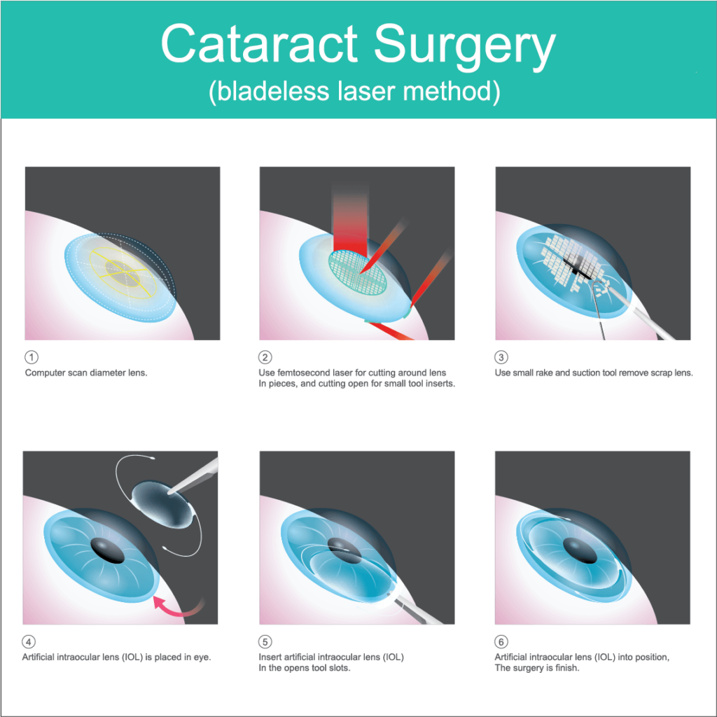 laser cataract surgery procedure illustration